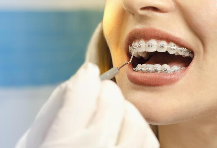 Diş Teli Fiyatları 2022: Şeffaf Plak, Lingual, Porselen ve Metal Diş Teli Fiyatları Ne Kadar?